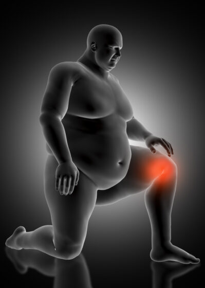 Novo remédio registra a maior perda de peso já registrada entre medicamentos para obesidade 2 O medicamento também mostrou melhora significativa da dor em pacientes com osteoartrite no joelho